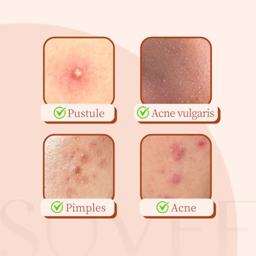 Pimple Patches for Face ? 96 Count Hydrocolloid Acne Patch with Salicylic Acid, Tea Tree & Centella ? Zit Patches for Blemishes, Breakouts & Spot Treatment