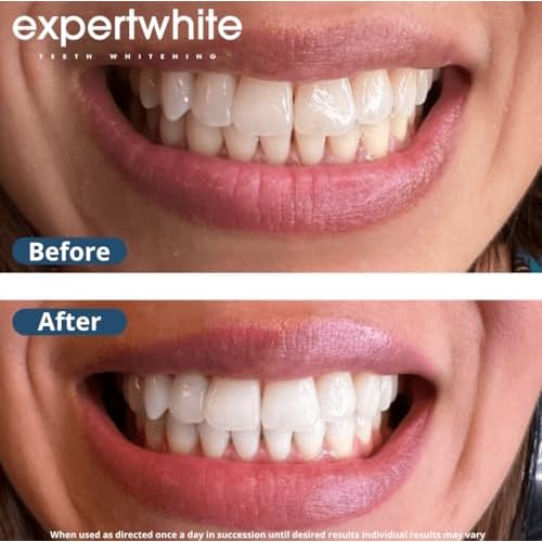 Teeth Whitening Gel Refills (6-gels). Made USA. 44 percent Carbamide Peroxide Tooth Bleaching Gel bleach For Invisalign style trays, Dental Grade Tooth Whitener. 6 syringes