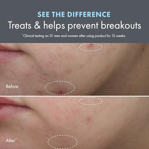 Origins Clear Improvement Acne Moisturizer | To Clear & Prevent Acne Breakouts & Pimples | With Salicylic Acid & Hyaluronic Acid, 1.7 Fl Oz