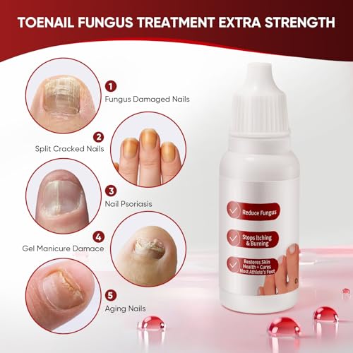 Toenail Treatment,Gentle Formula, Effectively Improves Nails for a More Beautiful Appearance