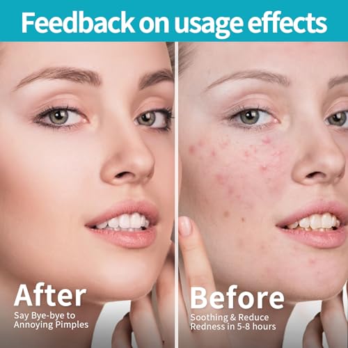 Pimple Patches for Face (648 Count),3 shapes (Round,Star and heart Shapes),Hydrocolloid Spot Dots with Salicylic Acid and Tea Tree Oil