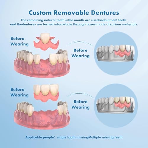 Partial Dentures - Custom Removable Personalized Tooth Replacement Set for Missing Teeth & Gap (2 Teeth)