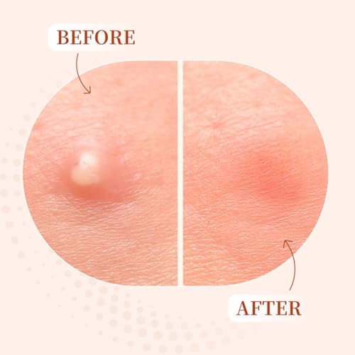 Pimple Patches for Face ? 96 Count Hydrocolloid Acne Patch with Salicylic Acid, Tea Tree & Centella ? Zit Patches for Blemishes, Breakouts & Spot Treatment