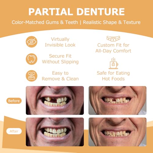 Partial Dentures - Dentures for Missing Teeth & Gaps - Lightweight & Unbreakable Replacement Teeth for Men & Women (2 Teeth)