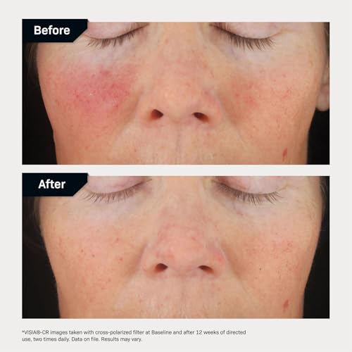 Revision Skincare C+ Correcting Complex 30%¢ç Vitamin C Serum for Face ? Anti-Aging Treatment to Brighten Skin, Reduce Fine Lines, Wrinkles & Dark Spots, Firming & Safe for Sensitive Skin