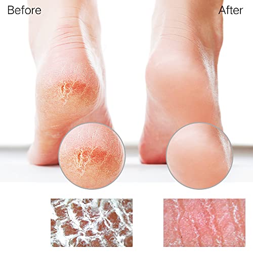 Glass Foot File Callus Remover for Feet, Heel Scraper, Pumice Stone, Diabetic Feet Scrubber Dead Skin Remover for Feet Professional Pedicure Tools