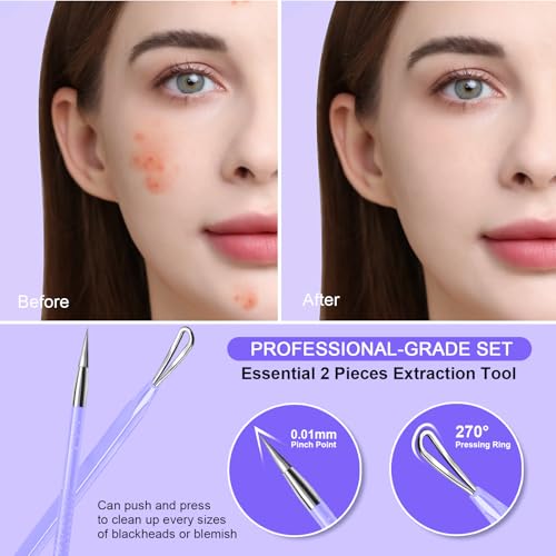 Teenitor Pimple Extractor Acne Treatment Tool Blackhead Comedone Removal 2-in-1 Popper Tool for Face Blackhead Extractor Tool Purple