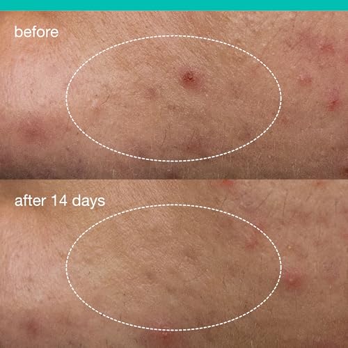 Dermalogica Deep Acne Liquid Patch, Sulfur Acne Treatment with Niacinamide, Invisible Spot Treatment for Blemish-Prone Skin ? 0.5 fl oz