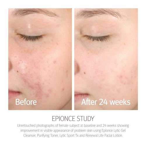 Epionce Renewal Lite Facial Lotion - Lightweight Hydrating, Anti-Aging Moisturizer for Combination to Oily & Problem Skin, Dermatologist Skincare