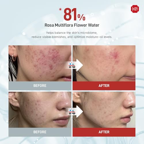 Zeroca 81 Korean Calming Cream for Acne-Prone & Sensitive Skin ? Lightweight and gentle daily soothing moisturizer, Controls Sebum, Deeply Hydrates & Smooths Texture (2.02 fl.oz. 60 ml)