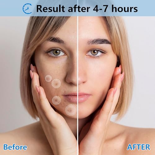 Invisible Pimple Patches for Face,Day and Night 4 Sizes 360 Counts Thin & Thick Hydrocolloid Acne Patches for Face and Skin, Zits Absorbing Patch, Covering Zits and Blemishes, Spot Stickers