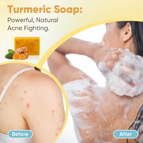 Treeroot 5 Pack Turmeric Soap for Dark Spots, 80g Kojic Acid and Turmeric Soap Bar, Face Even Skin Tone, Natural Potent Moisturizing Ingredient, Contains Vitamin C, Shea Butter, Lemon Oil, Retinol