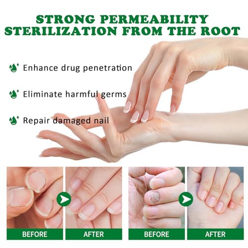 3Pcs Ginger Nail Treatment, 7days Nail Growth Serum Solution, Ginger Cuticle Care Oil for Nails Strengthener, Promote Nail Healthy Grow(30ml)