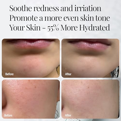 CICA Aloe Hydrating Toner Spray for Face - pH Balanced Facial Mist - Aloe Vera and Centella Asiatica - for Acne Prone and Sensitive Skin - Korean Skincare for Redness, Dryness