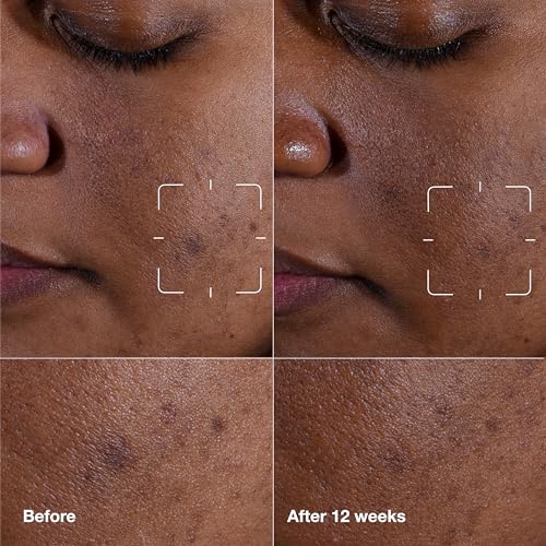 Clinique Even Better Clinical Dark Spot Clearing Vitamin C Face Serum For All Skin Types | Brightening + Soothing