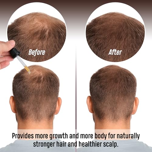 GF Hair Growth Serum for Men & Women ? DHT Blocker, Anti Hair Loss Treatment, Stimulates Hair Regrowth, Thickens & Strengthens Follicles, Healthy Scalp Support, 4 Months Supply (4x30 ML)