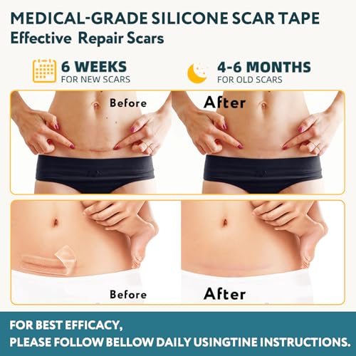 Silicone Scar Tape - 120" x 1.6" Roll - 3M, Extra Long Scar Sheets Medical Grade Reusable Scar Removal for Surgical Scars, C-Section, Tummy Tuck, Keloid and Acne