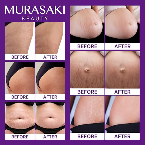 Stretch Mark Cream Prevention for Pregnancy - Maternity Cream for Stretch Marks Removal | Nourishing Formula ? Prevents Stretch Marks & Improves Elasticity - 4 oz (120g) (4 oz (120g))