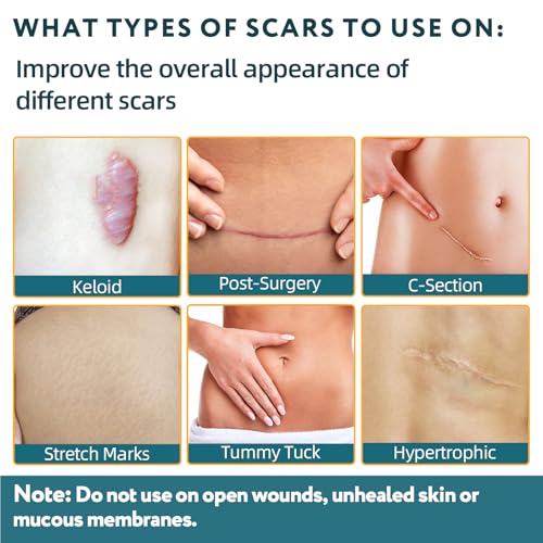 Silicone Scar Tape - 120" x 1.6" Roll - 3M, Extra Long Scar Sheets Medical Grade Reusable Scar Removal for Surgical Scars, C-Section, Tummy Tuck, Keloid and Acne