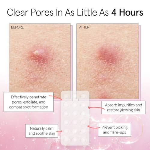 grace & stella Award Winning Pimple Patches for Face - Dermatologist Tested Acne Patches - Hydrocolloid Patch for Breakouts, Whiteheads - Vegan Acne Spot Treatment for Face (Invisible, 216 Count)