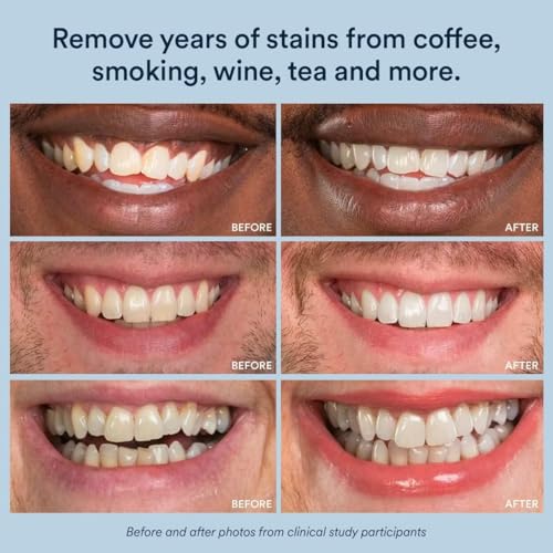 Auraglow Extra Strength Teeth Whitening Pen, 9% Hydrogen Peroxide, 40+ Whitening Treatments, Whitens Teeth Fast, No Sensitivity, 4mL