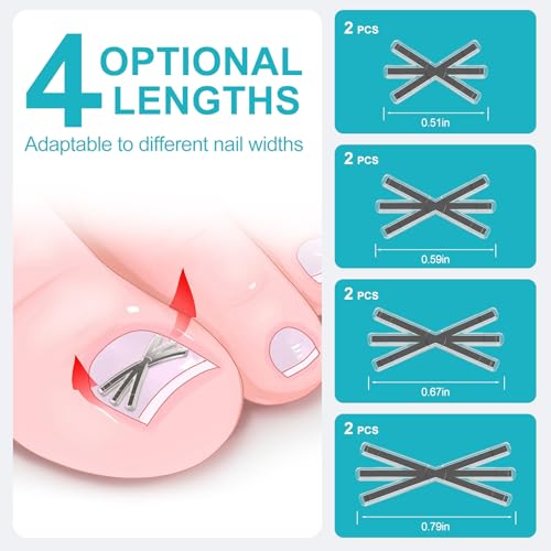 Ingrown Toenail Treatment Kit with Upgraded 6-Angle Shape,Titanium Alloy Ingrown Nail Corrector Tools with 4 Multi-Sizes,Ingrown Toe Nail Relief Remover Strips for Curved Toenail Quick Relief,8Pcs