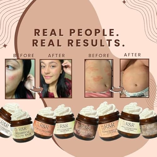Frankincense Tallow Face Moisturizer ? 100% Grass-Fed Whipped Beef Tallow Balm for Dry, Sensitive Skin, Eczema & Psoriasis ? Handmade Natural Skincare ? 2 oz