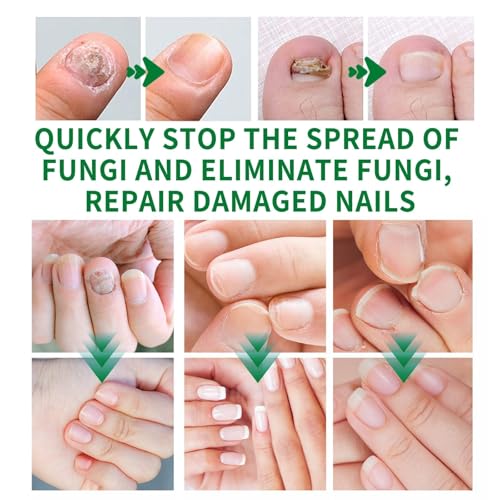 Ginger Nail Treatment, Ginger Cuticle Care Oil for Nails (2 PCS)