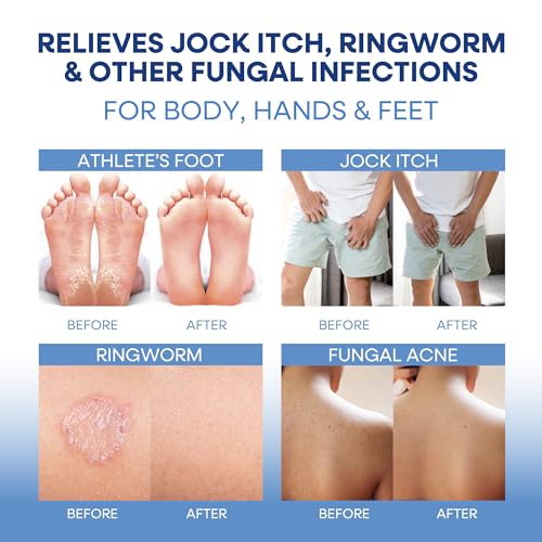 Hermon Antifungal Soap with Tea Tree Oil: Antifungal Bar Soothing Care & Relief of Itchy for Ringworm Jock Itch Tinea Versicolor Athletes Foot - Body & Face Wash (4 Ounce (Pack of 4))