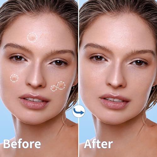 Pimple Patches for Face, 4 Size 300 Counts Acne Patches, Hydrocolloid Patches for Covering Zits and Blemishes, Spot Stickers with Salicylic Acid, Tea Tree Oil & Calendula Oil