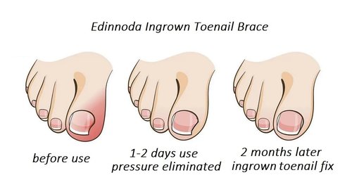 Edinnoda Ingrown Toenail Corrector | Toe Nail Brace for Curved Toe Nail | Toe Nail Lifter for Ingrown Treatment (Adult Largest Toenail Only) (Upgraded Brace, Patent Pending) (20 mm)