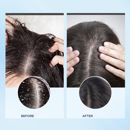 Bablabear Scalp Exfoliator Scrub,Itchy Scalp Treatment for Dandruff, No Sulfate Hair Scrub To Soothe a Dry, Flaky,Scalp,Removes Buildup,Clarifying Shampoo.