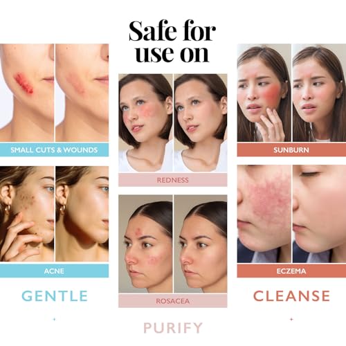 Hypochlorous Acid Spray for Face and Skin | Piercing Aftercare Spray | 8 oz Hypochlorous Acid Sprays for Face, Skin, Acne, Eczema, Body Acne Sprays, Piercing Aftercare, Facial Wound Solution, Workout
