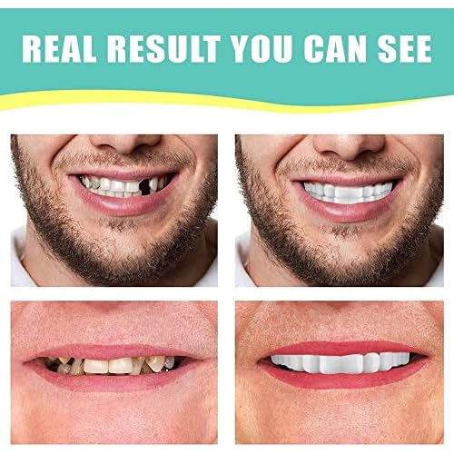 1Set Dentures Veneers Tooth,Dental Care Kits for Anti Molar Orthodontic Cosmetic Teeth,Smile Snap Tooth.(White,1Top+ 1Bottom+2Adhesives+1Tweezers+1Heart-Shaped Storage Box£©