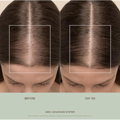VEGAMOUR GRO+ Advanced Hair Serum for Hair Density, Reduces Shedding and Promotes a Healthy Scalp, Helps with Severe Signs of Thinning, Made Without Fragrance, Vegan, Cruelty-Free