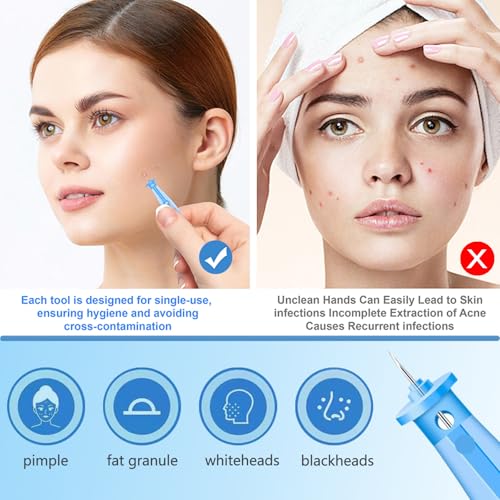 Sterile Needles for Pimples, 50 Pcs Disposable Sterile Pimple Needle and 72 Dots Acne Stickers, Pimple Popper Needle for Clear Skin, Acne Needles Tool for Milia Remover
