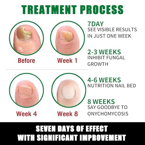 7 days Nail Treatment, Ginger Nail Treatment, Nail Growth Serum, Ginger Nail Serum, Nail Nutrient Oil Strengthener Oil (2 PCS)
