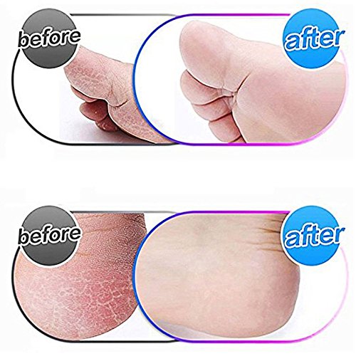 12 Pack Replacement Roller for Amope Pedi, Replacement Head Refills Compatible with Amope Pedi Refills Electronic Perfect Foot File-6 Extra Coarse & 6 Regular Coarse