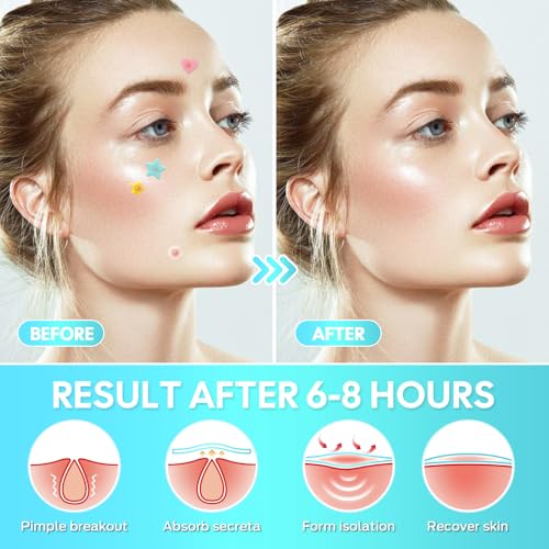 Pimple Patches,Hydrocolloid Star Pimple Patches for Face,Acne Patches for Face,Invisible Blemish Patches with Tea Tree, Salicylic Acid and Centella Asiatica 306 Count,Vegan,Suitable for All Skin Types