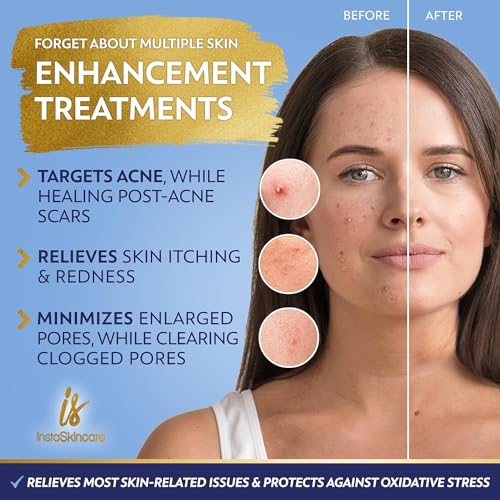 Niacinamide Serum 8Oz for Face 10% with Zinc 1% Vitamin B3 Brightening Serum for Tone, Texture