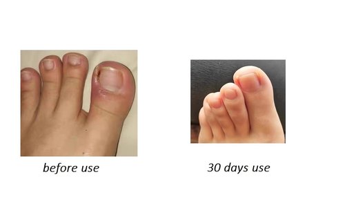 Edinnoda Ingrown Toenail Corrector | Toe Nail Brace for Curved Toe Nail | Toe Nail Lifter for Ingrown Treatment (Adult Largest Toenail Only) (Upgraded Brace, Patent Pending) (20 mm)