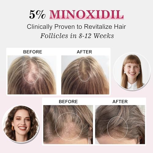 5% Minoxidil for Women Hair Regrowth Spray, hers hair regrowth treatment Infused with Biotin, Extra Strength Treatment to Combat Hair Loss and Thinning, 6 Bottles£¨100 Ml)