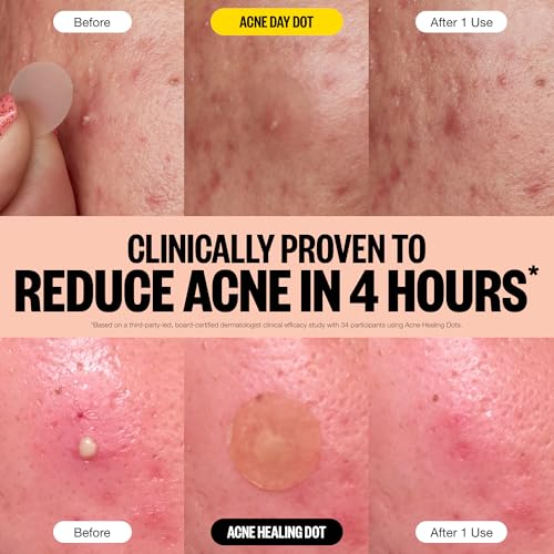 PEACE OUT Acne Day & Night Duo, Sheer Hydrocolloid Pimple Patches For Day Plus Overnight Acne Dots, Helps Clear Blemishes Quickly with Salicylic Acid, Retinol and Aloe Vera, 20 dots