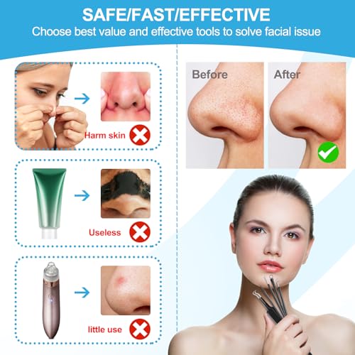 Blackhead Remover Tools Pimple Popper Tool Kit, Comedones Extractor Acne Removal Kit for Blemish, Black Head Remover for face Risk Free Treatment for Whitehead Popping