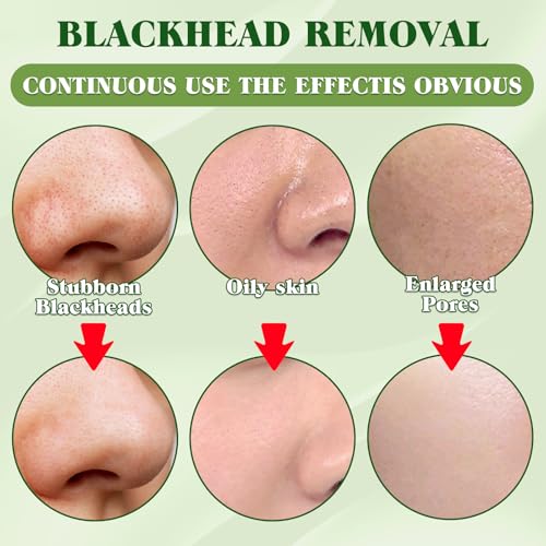 Blackhead Remover Strips, Charcoal Pore Strips, Deep Cleansing Blackhead Strip for All Skin Type, Nose Strip Blackhead Remover, Keep Skin Clear and Tighten Pores (10 pack)