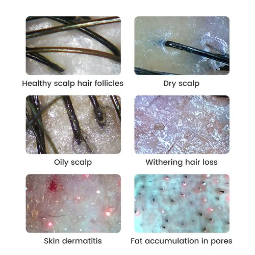 JBMBHC Handheld Dermatoscope Skin Analyzer Machine, Wireless Portable Digital Microscope with 1080P IPS Screen 8 LEDs, 500X Magnifier, for Scalp/Hair Trichomes Facial Skin Dermatoscope
