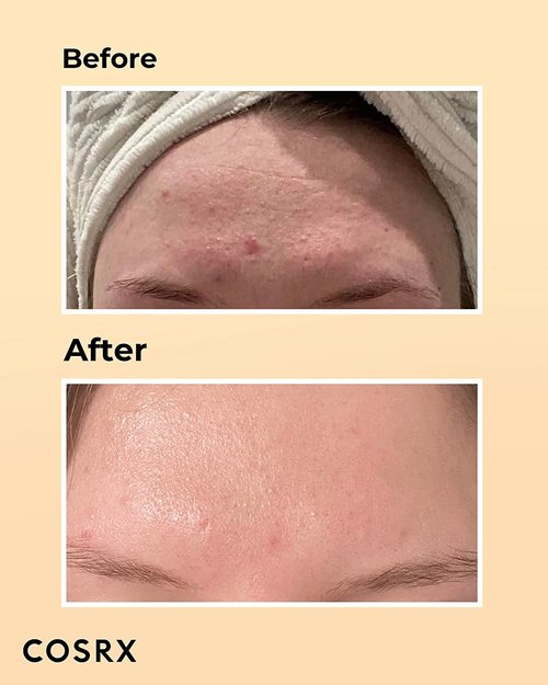 COSRX Post Acne Mark Recovery - Snail Mucin 96% Essence + Vitamin C 13% Serum, Intensive Hydrating for Fine lines, Hyperpigmentation, After Blemish Care