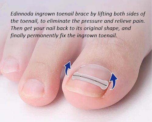 Edinnoda Ingrown Toenail Corrector | Toe Nail Brace for Curved Toe Nail | Toe Nail Lifter for Ingrown Treatment (Adult Largest Toenail Only) (Upgraded Brace, Patent Pending) (20 mm)