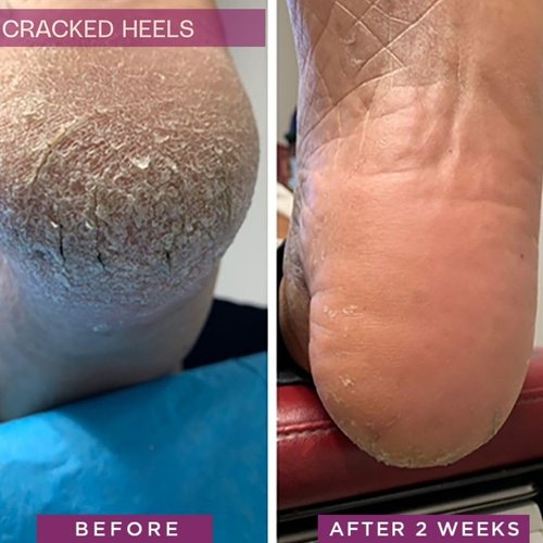 SkinIntegra Rapid Crack Repair Cream, 25% Urea with Lactic Acid, Heals Cracked Heels and Diabetic Feet, Post-Surgery Scar Care, Fragrance-Free Barrier Cream, 3 oz