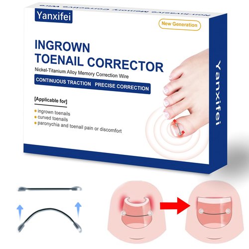 Nitinol Ingrown Toenail Corrector,at Home Ingrown Toenail Treatment,Curved Toenail Straightener,Ingrown Toe Nail Relief，Ingrown Toenail Removal Kit (1/2 In,11/16 In)
